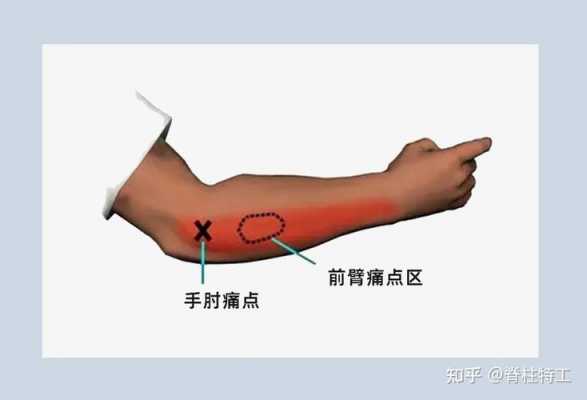 胳膊肘关节疼痛叫什么病