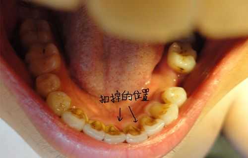 牙结石什么样子颜色