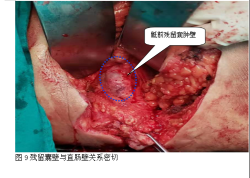 囊壁钙化是什么意思,囊肿囊壁钙化是什么意思 