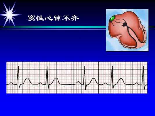 什么叫窦性心律不齐