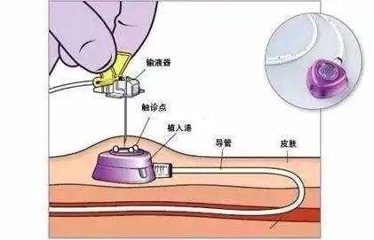 为什么要输液_手术前为什么要输液