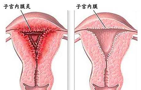  子宫粘连有什么症状「子宫粘连有什么症状图片」