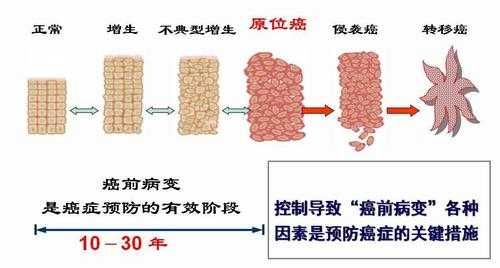 什么叫癌前病变癌前病变是癌症吗 什么叫癌