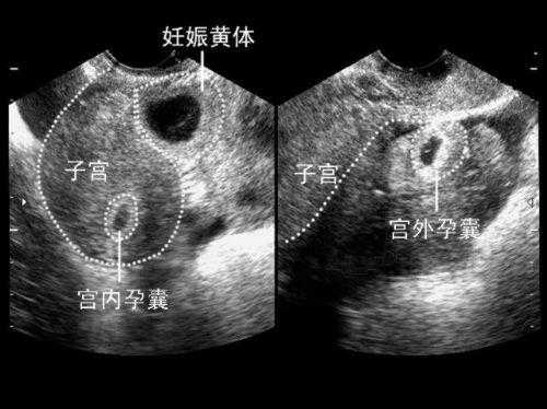 外宫怀孕有出现情况