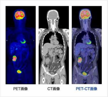 PETcT是什么意思-pet-ct是什么