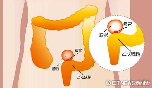  结肠是什么病「乙壮结肠是什么病」