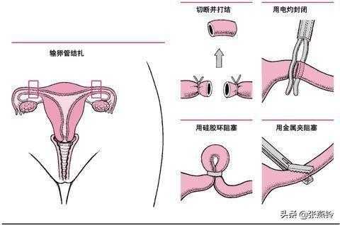 结扎和上环有区别吗