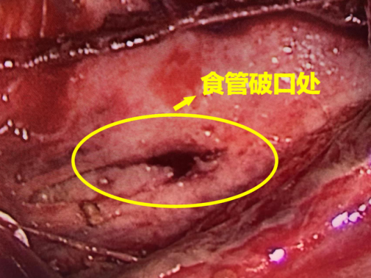 食管破裂严重吗