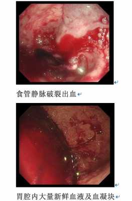 食管破裂严重吗