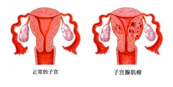 子宫轻度糜烂是什么原因引起的（子宫轻度糜烂是什么原因引起的呢）