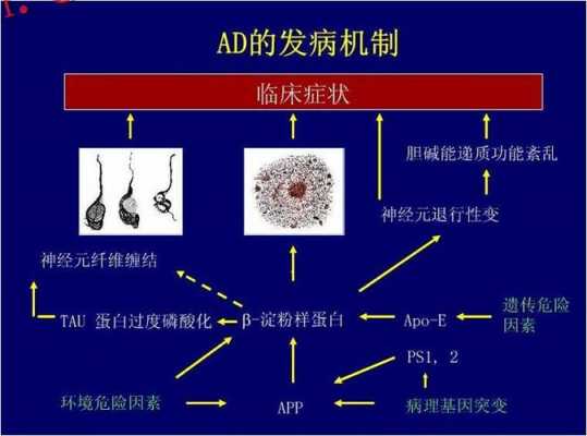 AD是什么疾病的缩写 ad是什么疾病