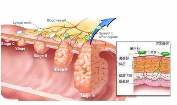  淋巴有什么症状「直肠癌转移淋巴有什么症状」