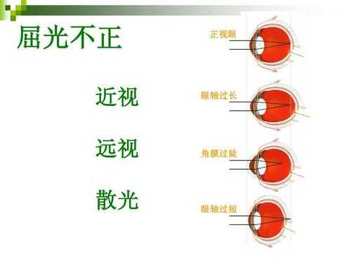 散光的轴位是什么意思图解