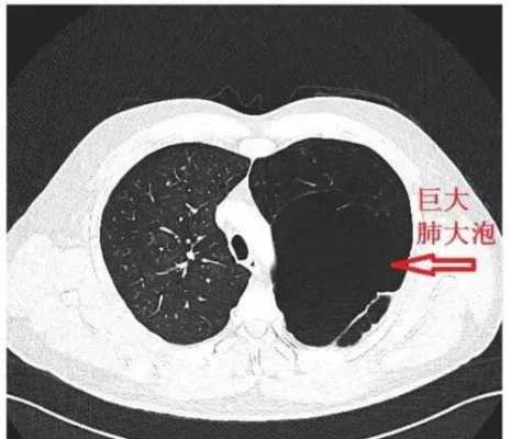 肺上长泡是什么病能治好吗 肺上长泡是什么病