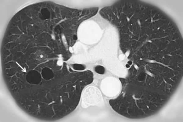 肺上长泡是什么病能治好吗 肺上长泡是什么病