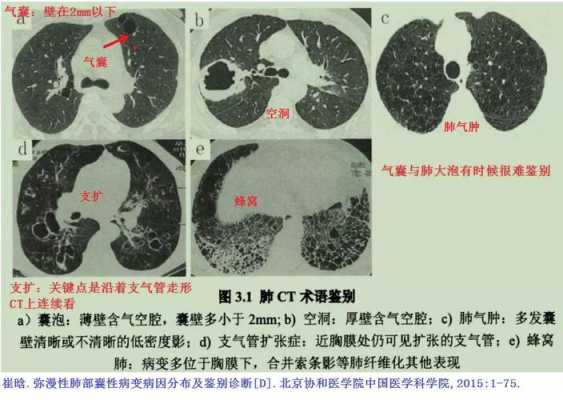 肺气囊是什么病严重吗,肺气囊是什么病? 