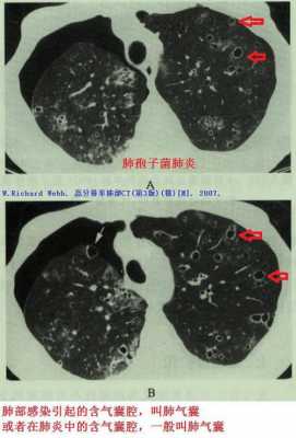 肺气囊是什么病严重吗,肺气囊是什么病? 