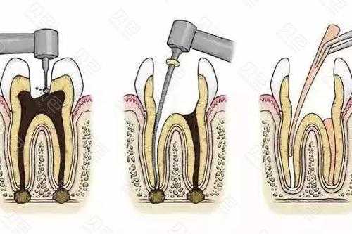 什么蛀牙,什么蛀牙要做根管治疗 