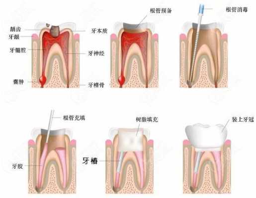 什么蛀牙,什么蛀牙要做根管治疗 