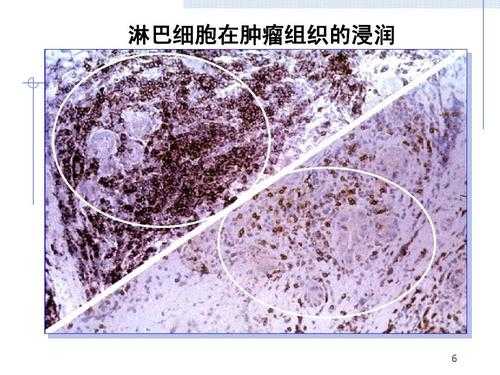 淋巴细胞浸润是什么意思,间质淋巴细胞浸润是什么意思 