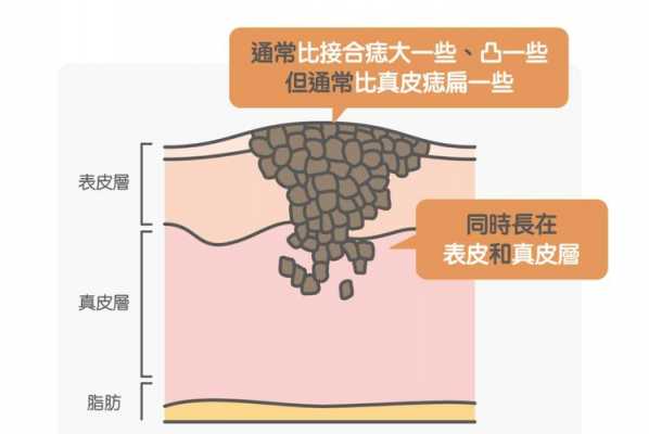 痣是怎么形成的