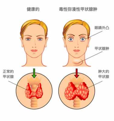 甲亢怎么治疗最好最快 甲亢是一种什么病严重吗