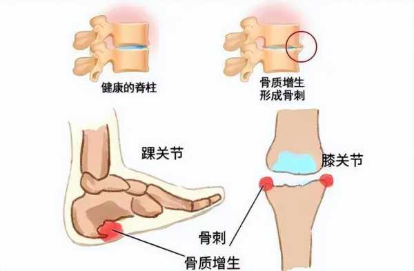 骨刺是什么意思? 骨刺是什么意思