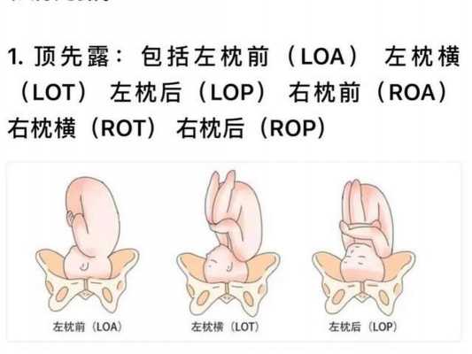 LOT胎位是什么意思吗-lot胎位是什么意思