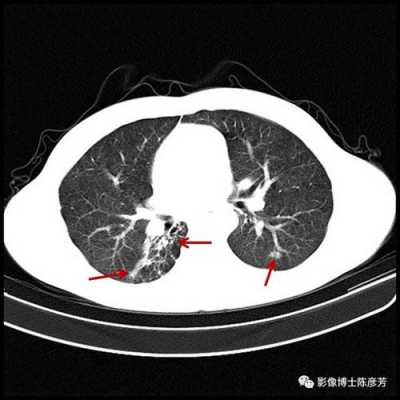 双肺斑索是什么意思,双肺斑索严重吗 