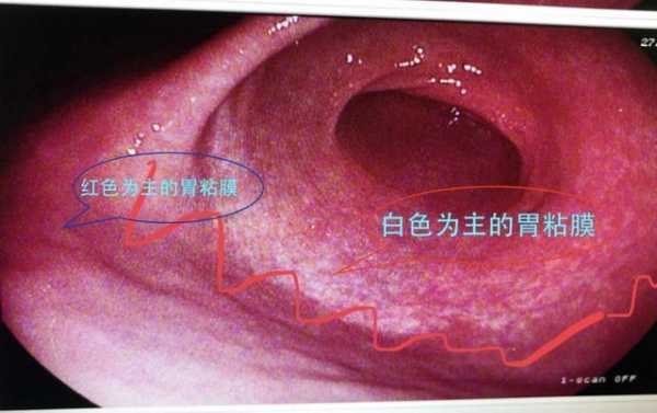 什么是慢性萎缩性胃炎C1 什么是慢性萎缩性胃炎