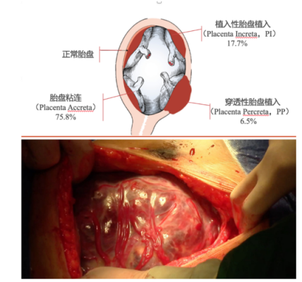 什么叫植入