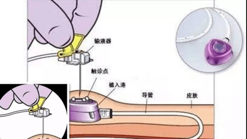 什么叫植入