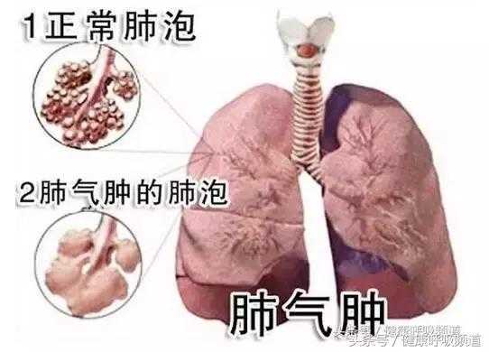 慢性支气管炎是什么引起的 气管炎是什么引起的