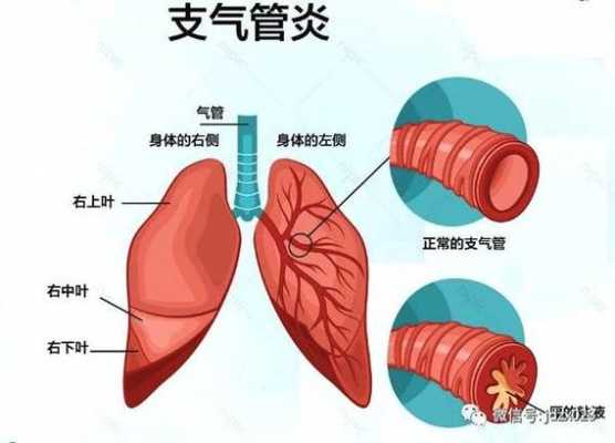 慢性支气管炎是什么引起的 气管炎是什么引起的