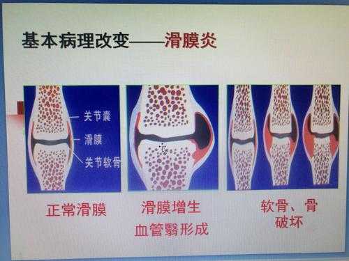 关节炎看什么科