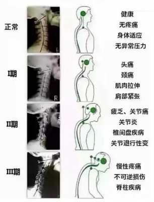 颈椎变直有什么症状,颈椎不好有什么症状出现 