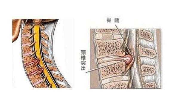 颈椎变直有什么症状,颈椎不好有什么症状出现 