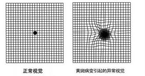 眼睛看东西变形扭曲是什么原因,眼睛看东西有波纹状是怎么回事 