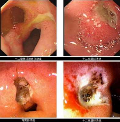 十二指肠溃疡是什么症状（十二指肠溃疡是什么症状表现怎么治）