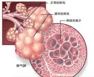 什么叫肺大泡（什么叫肺大泡肺气肿）