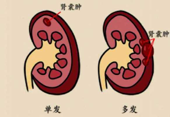 右肾囊肿要注意什么（右肾囊肿生活中应该怎样注意）