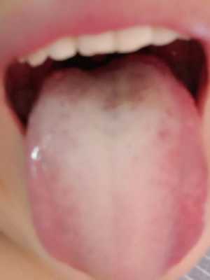 舌根不舒服是什么原因,总感觉像吃过生葱后的感觉-舌根不舒服是什么原因