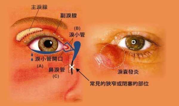 小孩流眼屎什么原因导致的-小孩流眼屎什么原因