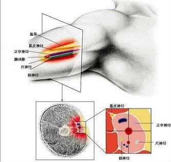 臂丛麻醉属于什么麻醉_臂丛麻醉最简单定位点