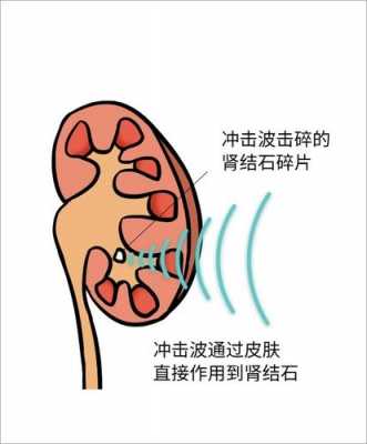  肾结石挂什么科「肾结石挂肾内科还是泌尿科」