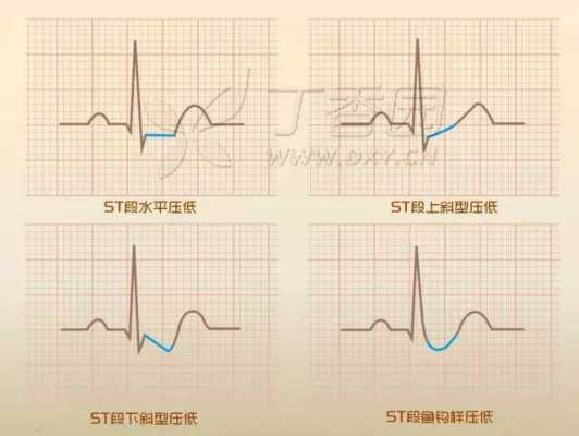 ST段抬高是什么意思