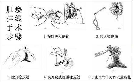 肛瘘什么意思（肛瘘挂线是什么意思）