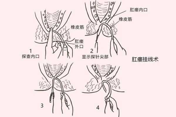 肛瘘什么意思（肛瘘挂线是什么意思）