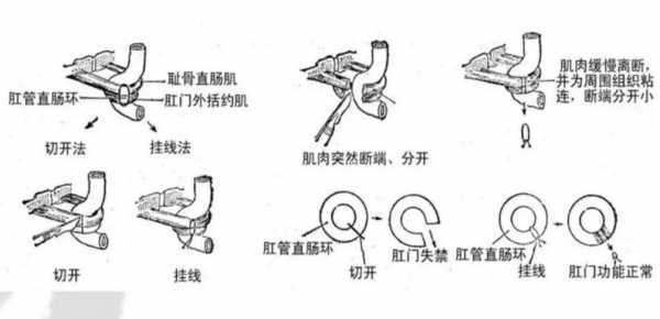 肛瘘什么意思（肛瘘挂线是什么意思）