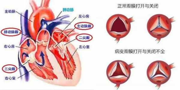 主动脉瓣返流是什么意思? 主动脉瓣返流是什么意思